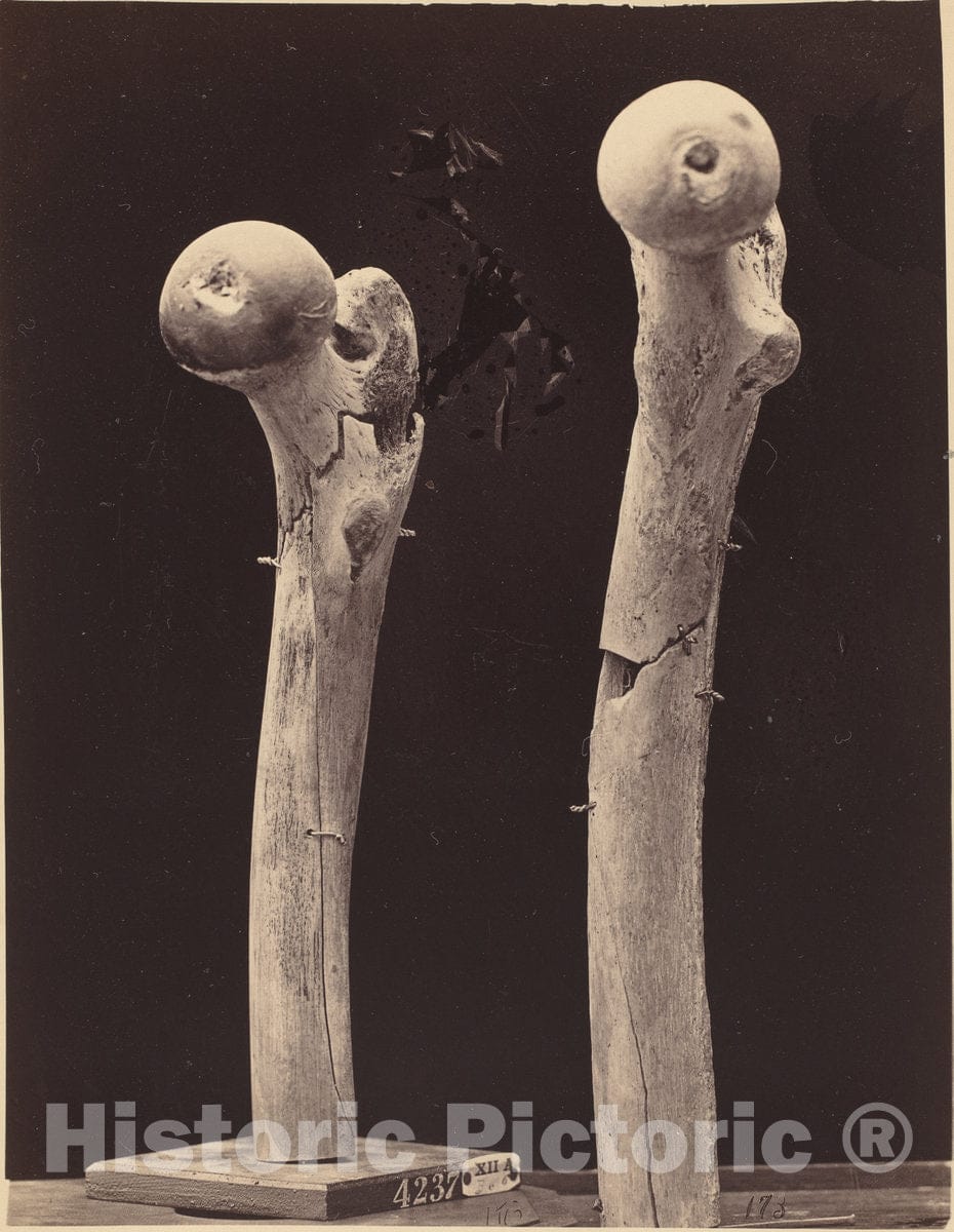 Art Print : Specimens of Gunshot Fractures of The Femur, c. 1867 - Vintage Wall Art